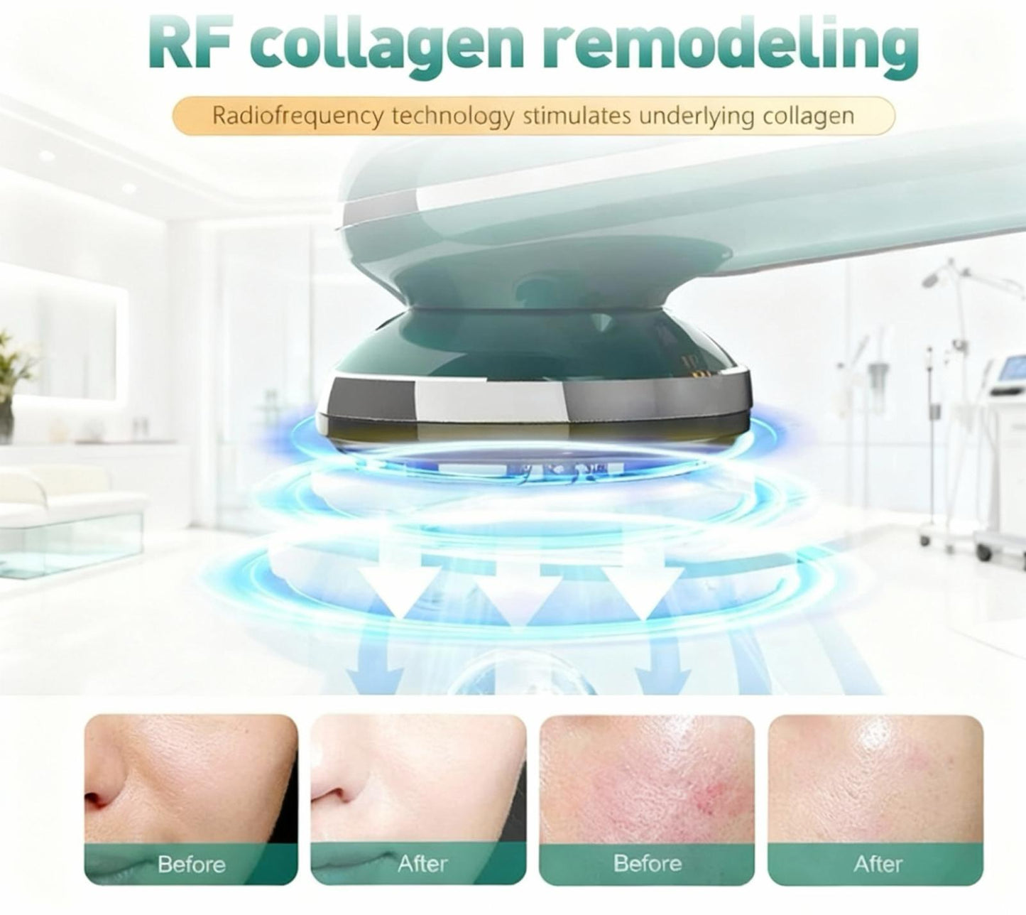 DermaLift Pro — RF + IPL Collagen Rejuvenation Wand